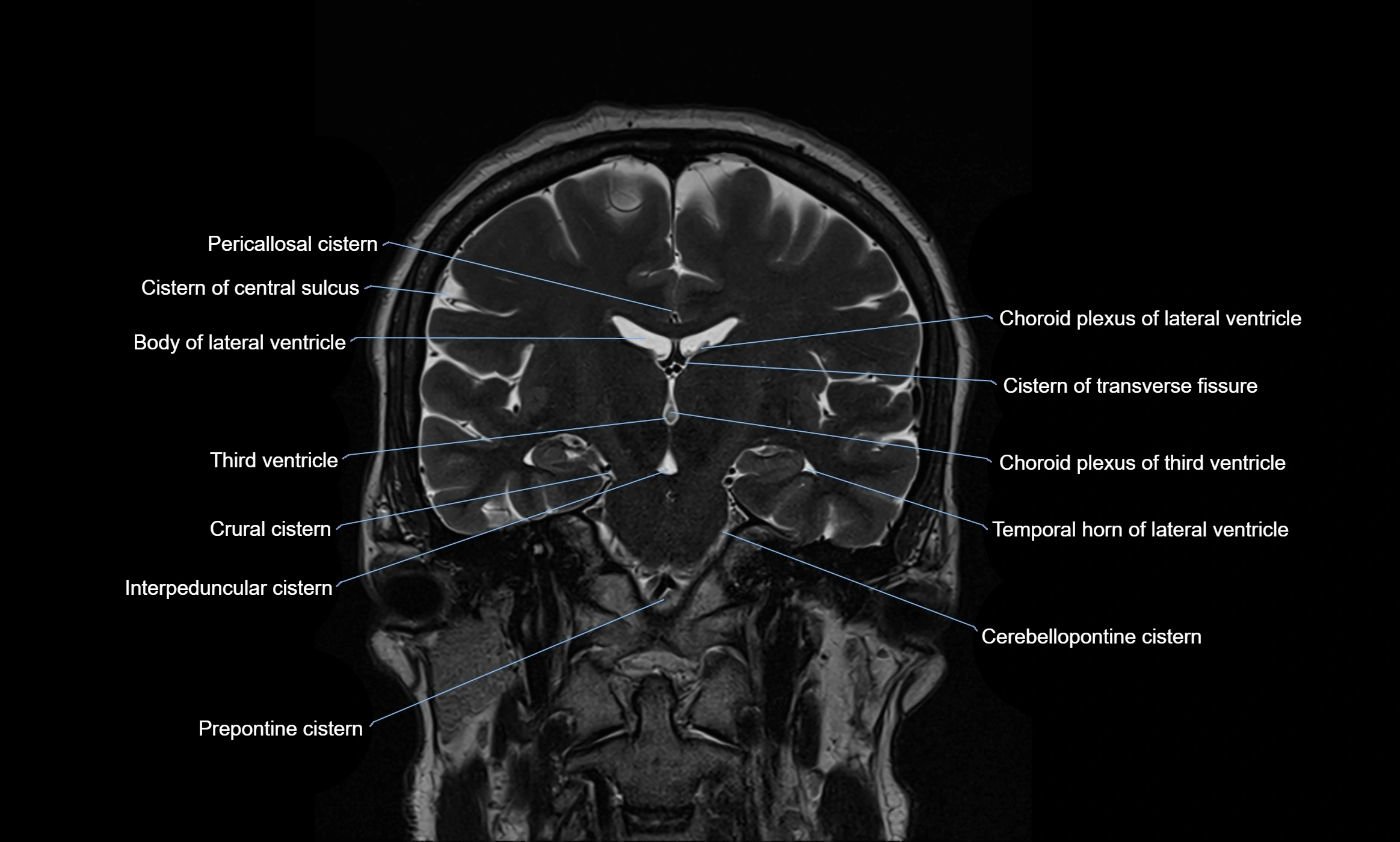 Brain cisterns  and ventricles coronal anatomy 3T MRI image-img-00001-00031.webp
